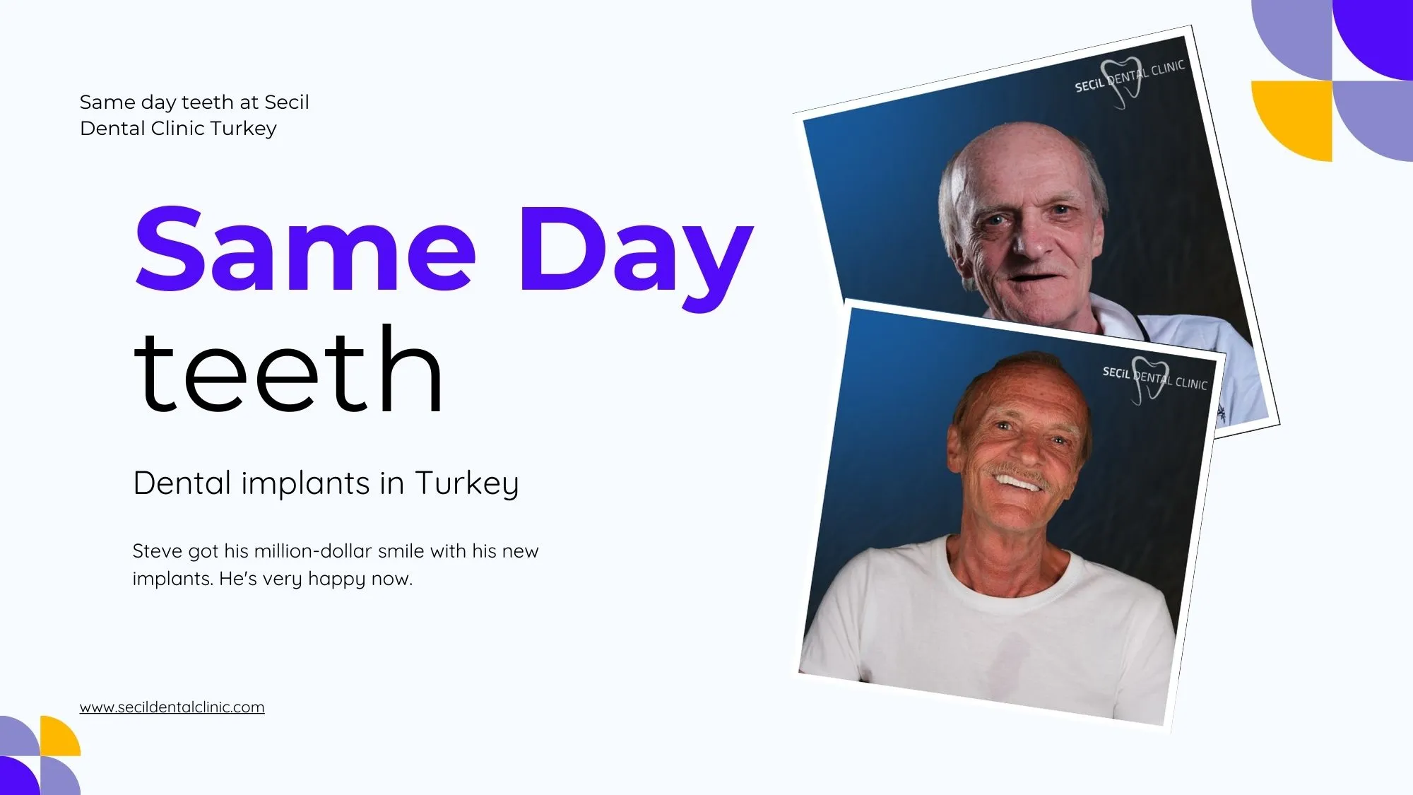 Same Day Teeth in Antalya Turkey